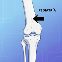 Inserción en fémur distal en pediatría