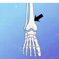 Punto de punción en la tibia distal